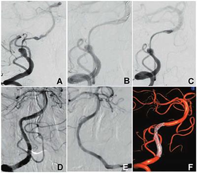 Endovascular treatment of intracranial vertebral artery unruptured dissecting aneurysms: Comparison of flow diversion and stent-assisted coiling or stenting alone